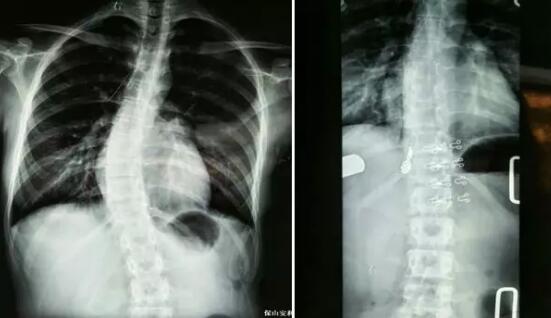 好好的脊柱怎么說彎就彎了？你竟然都沒發(fā)現(xiàn)……