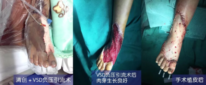 車禍猛如虎，救治如“華佗” ，手術(shù)＋康復(fù)，8歲小女孩車禍后日漸康復(fù)行走