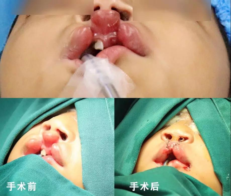 唇腭裂盡早治療消除孩子自卑心理，快樂成長！