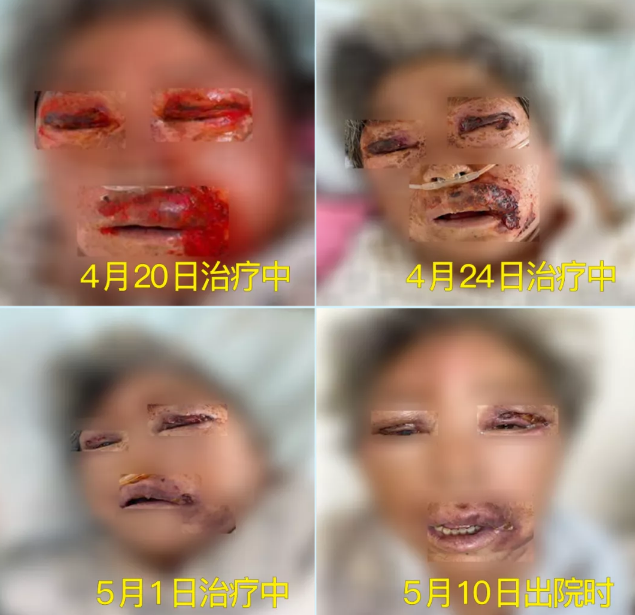 膿毒血癥（急性頜面部蜂窩組織炎）多學科聯(lián)合會診，幫助患者成功治愈！