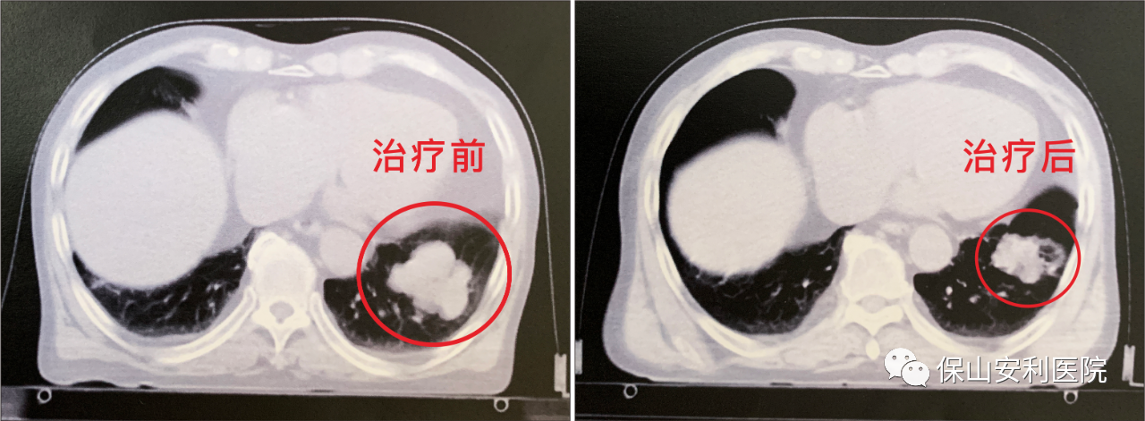 不做手術(shù)，早期肺癌也能根治！
