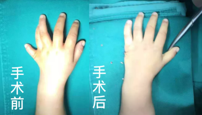 【保山安利醫(yī)院】2歲小兒手、足多指（趾）成功修復(fù)(矯正）！