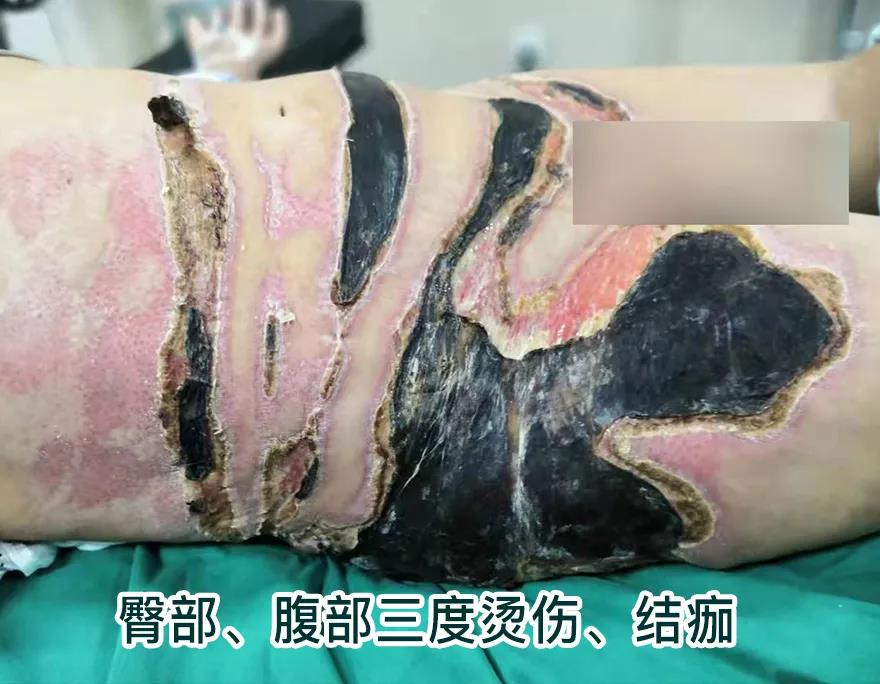 【保山安利醫(yī)院】80歲老人不慎燒傷，導(dǎo)致腹部、右側(cè)臀部大面積創(chuàng)傷，經(jīng)植皮治療創(chuàng)面逐漸愈合