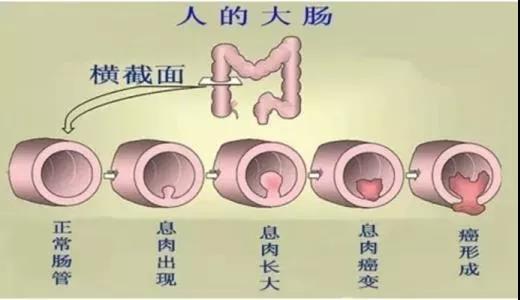體檢發(fā)現(xiàn)腸息肉會(huì)癌變嗎？