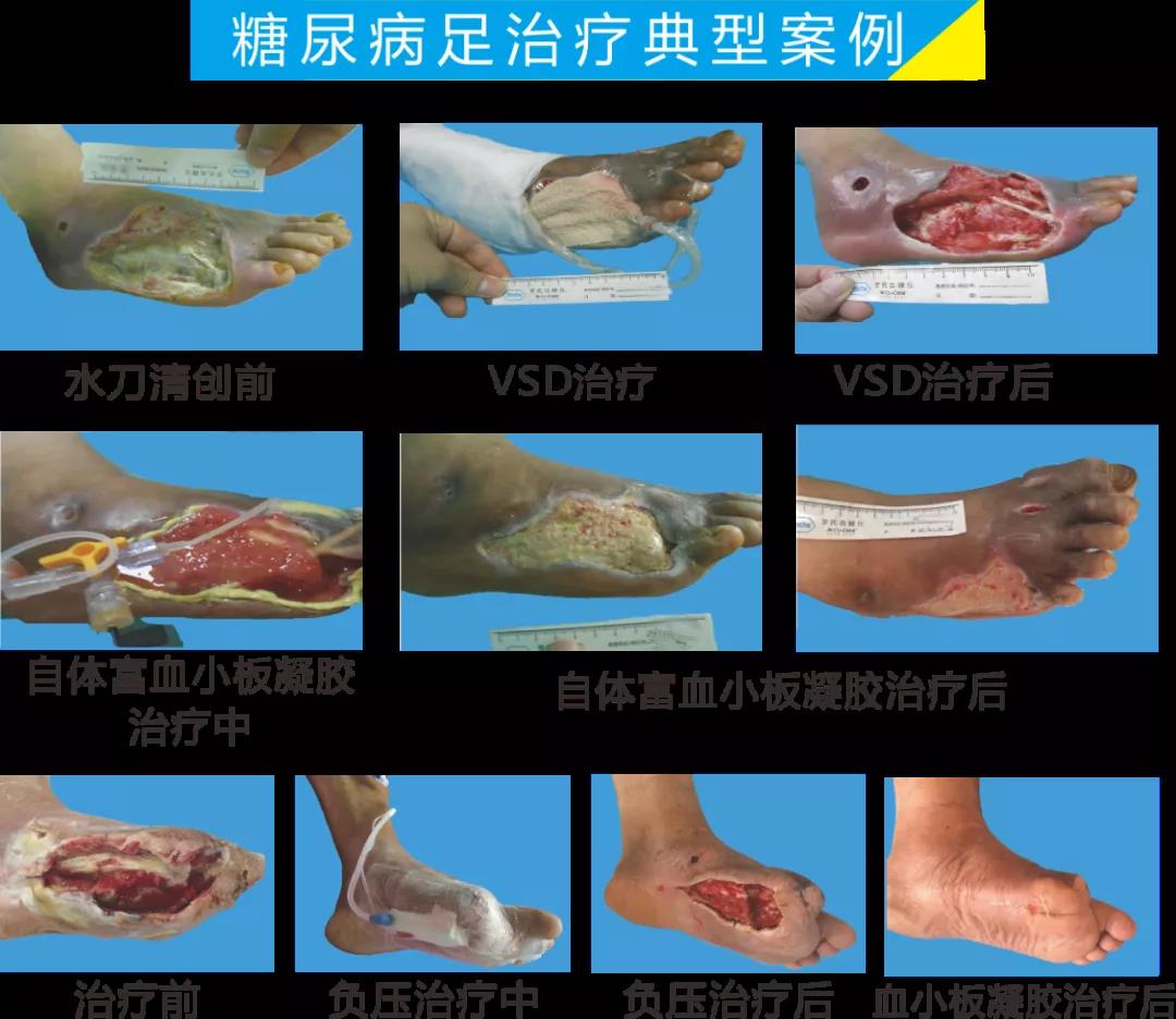 截肢、失明，甚至……，我們要做的是將糖尿病并發(fā)癥遏制在搖籃里！