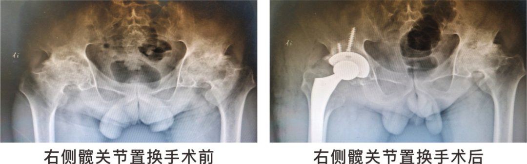 【保山安利醫(yī)院】長期飲酒導(dǎo)致雙側(cè)股骨頭壞死，髖關(guān)節(jié)置換后重獲運動功能！