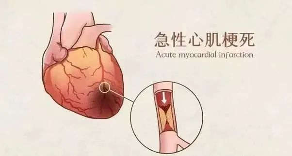 【保山安利醫(yī)院】11月20日“心梗救治日” 時(shí)間就是心肌，時(shí)間就是生命！