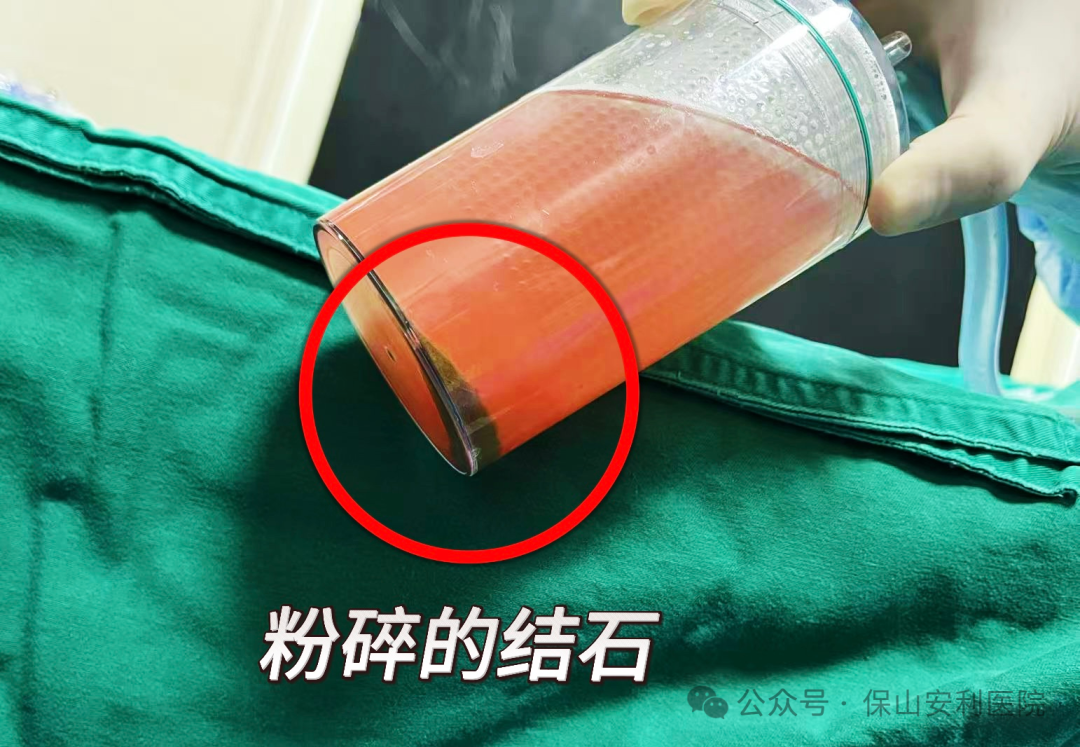 科普丨泌尿結(jié)石“克星”鈥激光碎石術(shù)，手術(shù)動(dòng)圖揭秘全過(guò)程！